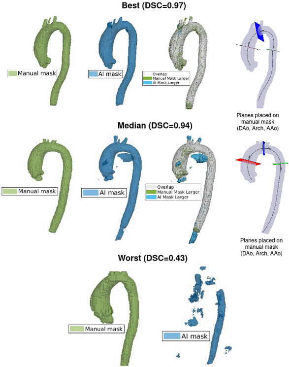 Fully Automated AI-Driven Quantification of Thoracic Aorta Dimensions From Contrast-Enhanced MRA (Pending Acceptance) thumbnail